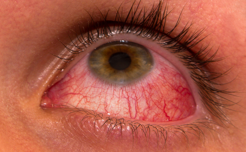 Risk of eye diseases